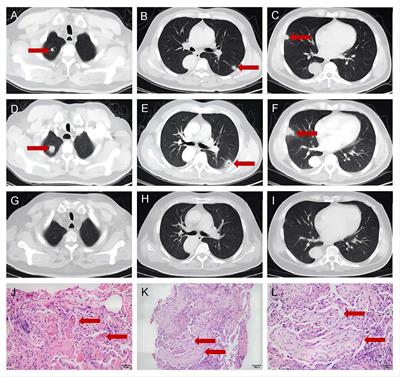 Case report: Coexistence of triple-seronegative myasthenia gravis and pathology-proven cryptogenic organizing pneumonia